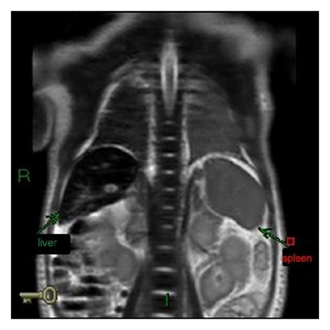 Follow Up Abdominal Mri Coronal View At 8 Months Showing Normal