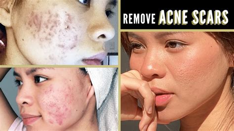 How To Get Rid Of Acne Scars For Good Youtube