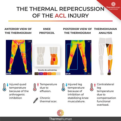 Anterior Cruciate Ligament Acl And Thermography Assessment A Review