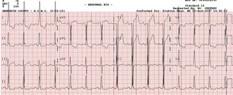 Dr Smiths Ecg Blog Lvh With Secondary St Depression