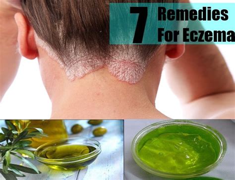 How To Get Rid Of Eczema Home Remedies For Eczema Eczema Remedies