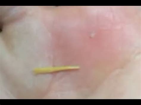 How do you remove a thorn from a finger or another part of the body? Splinter Removal - Remove Thorn In hand - YouTube