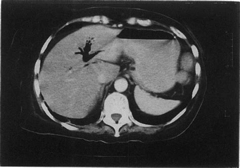 Abdominal Ct Scan Showing Gas Within The Intrahepatic Biliary System
