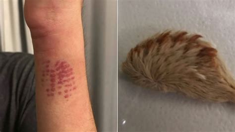 Florida Teen Lands In Emergency Room After Encounter With Venomous