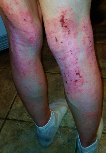 Severe Atopic Dermatitis Legs 14 Years Old Severe Derm Flickr