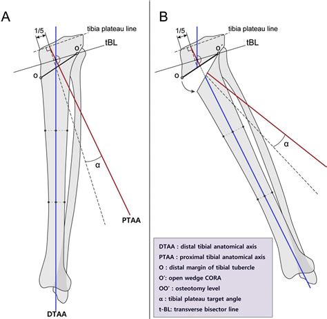 Proximal Tibial Anterior Open Wedge Oblique Osteotomy A Novel