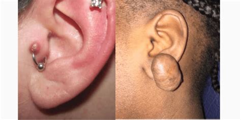 Piercing Bump Vs Keloid What Is The Difference Pictures