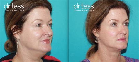 Double Chin Reduction Treatment Melbourne Dr Tass