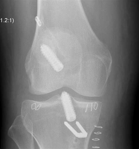 Revision Acl Cases The Bone School
