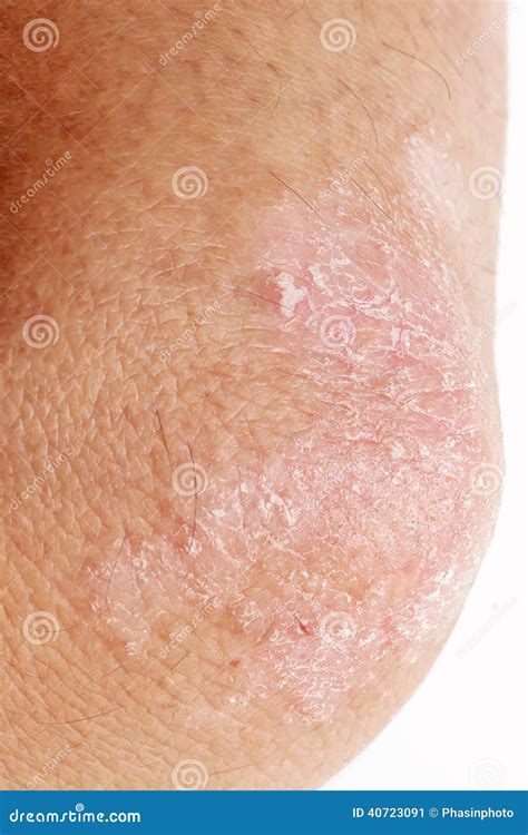 Psoriasis On The Elbow Closeup Dermatitis On Skin Ill Allergic Rash