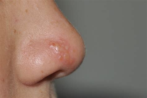 Herpes Simples Nasal Gilberto M Palma Flickr