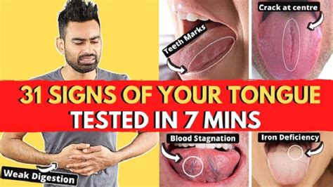 31 Tongue Signs Your Body Is Asking For Help With Solutions Video