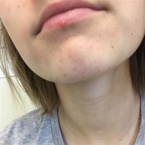 I Have This Wierd Bump On My Lip What Is It Plz Help Xoxo Glow