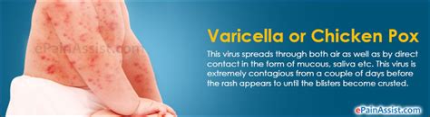 Varicella Treatment Prevention Dos And Donts Symptoms