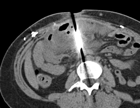 Ct Of Penetrating Abdominopelvic Trauma Radiographics