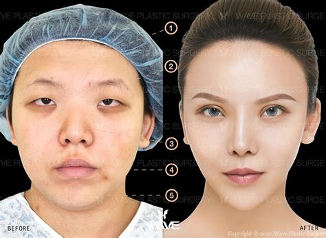 Transformation Gallery Wave Plastic Surgery