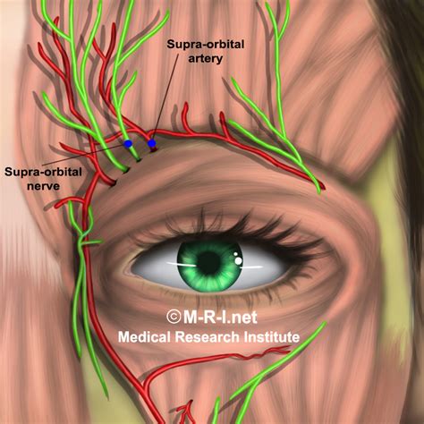 Surpaorbital Supratrochlear Nerve Blocks Effective In Migraine A