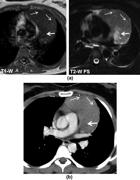 Imaging Of Thymus In Myasthenia Gravis From Thymic Hyperplasia To