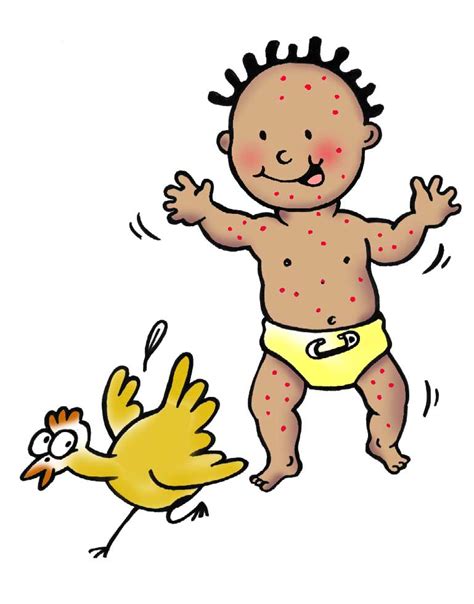 Clipart Chicken Pox 20 Free Cliparts Download Images On Clipground 2024