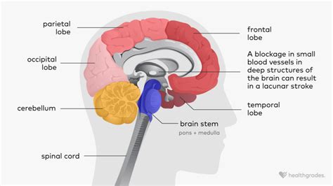 Lacunar Stroke Symptoms Causes Treatments And More
