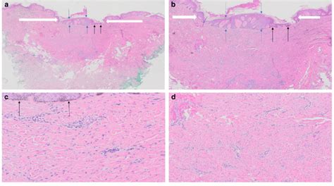 Atrophic Dermatofibroma On The Left Upper Back Of A 64 Year Old Download Scientific Diagram