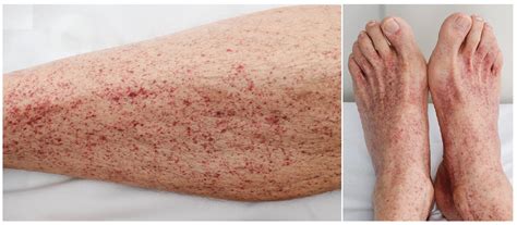 What Is Petechiae Know The Symptoms Causes And Treatment Of The Disease