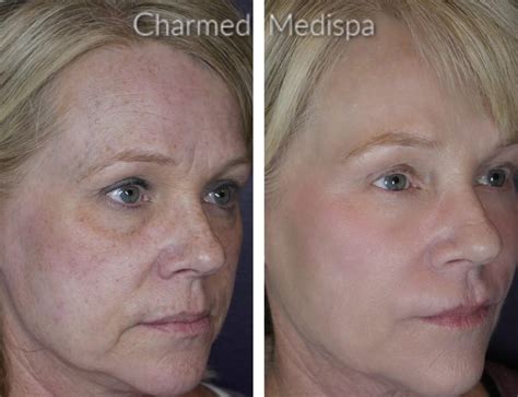 The Ultimate Combination Therapies Ipl Skin Care Microneedling And