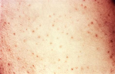 Medical Pictures Info Petechiae