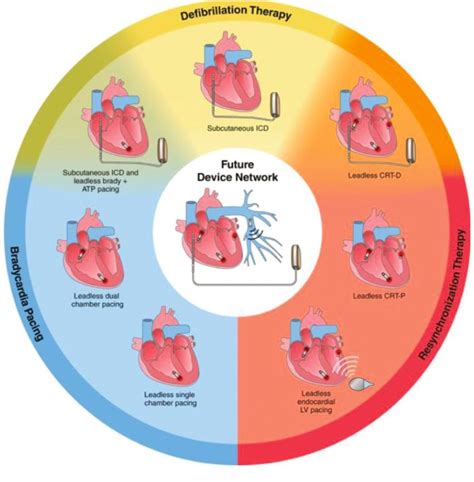 Racgp Cardiac Rhythm Management Devices Cardiac Rhythms Cardiac