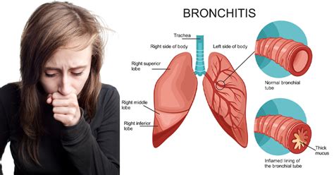 How Long Will Bronchitis Persist Medguidance