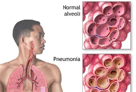What Are The 4 Stages Of Pneumonia