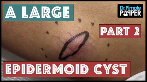 An Extra Elbow A Floatation Device Or An Epidermoid Cyst Part 2 Of