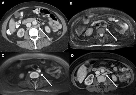 A 68 Year Old Female Presented With Weight Loss And Jaundice Axial
