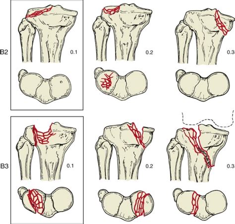 Tibial Plateau Fractures Musculoskeletal Key