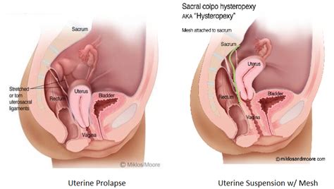 Numerous individuals have identified rodents in their walls or in their storage rooms after their cats would sit in a particular spot and appear to gaze through the mortar. UTERINE - fallen uterus - Vaginoplasty.com - All About ...