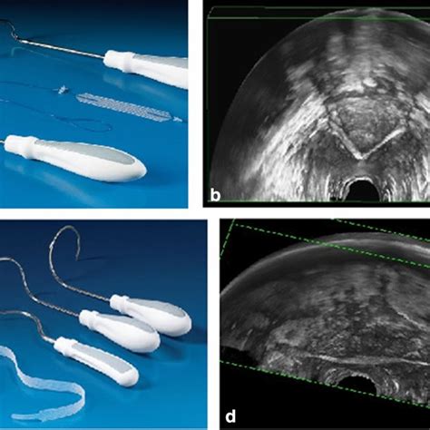 A And B Transperineal 3d Ultrasound Images In Patient With Persisting