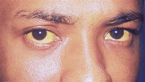 Jaundice Causes Of Yellow Eyes And Skin Air Clinic Social