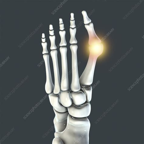 Bunion Illustration Stock Image F Science Photo Library
