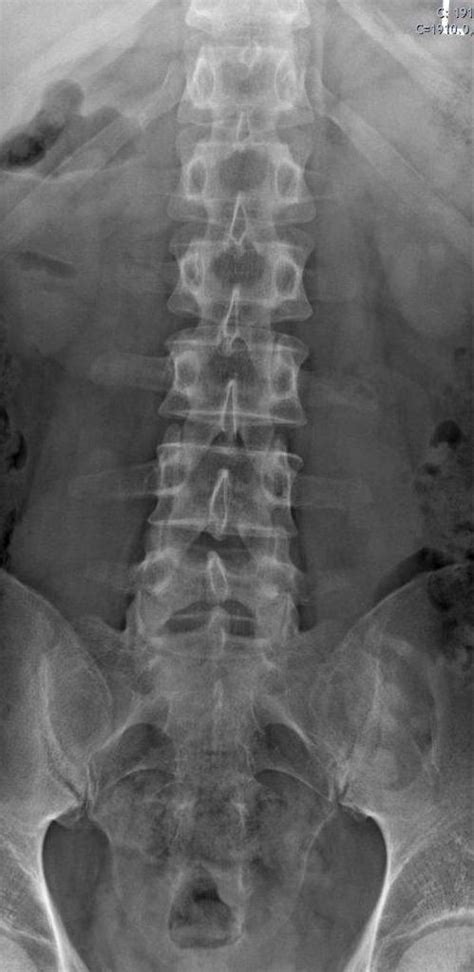 Laumbar Spine 2 Buyxraysonline