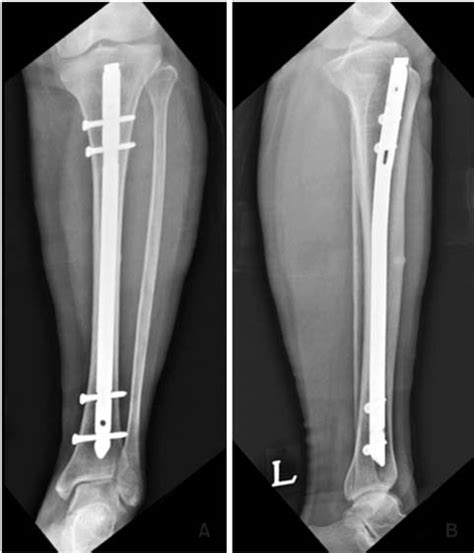 Atypical Fracture Like Insufficiency Fracture Of The Tibia With