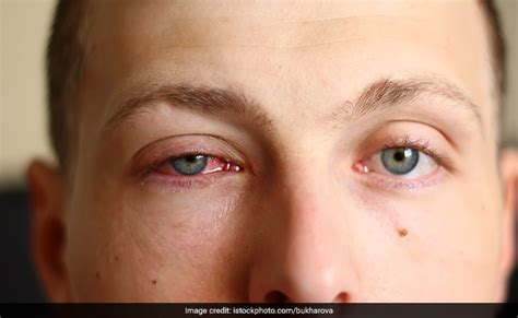Allergic Conjunctivitis These Home Remedies Are Useful When The Eyes Become Red Or Red Soon