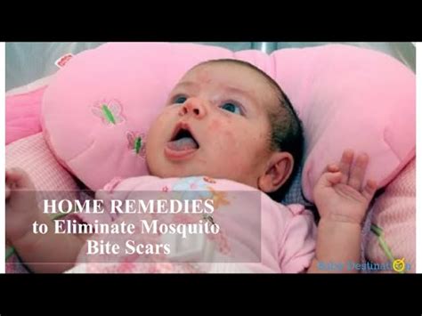 Home Remedies To Eliminate Mosquito Bite Scars