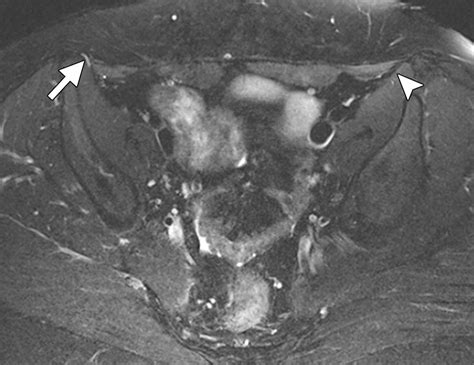 High Resolution 3 T Mr Neurography Of The Lumbosacral Plexus