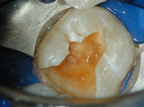 Endodontics Pulp Capping