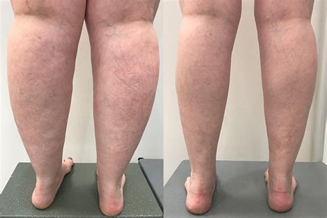 Before And After Liposuction For Lipoedema Vein Health Clinic Melbourne