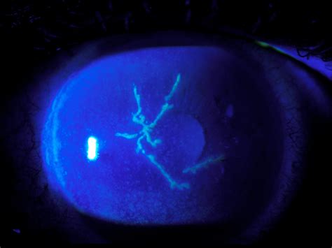 Moran Core Fluorescein