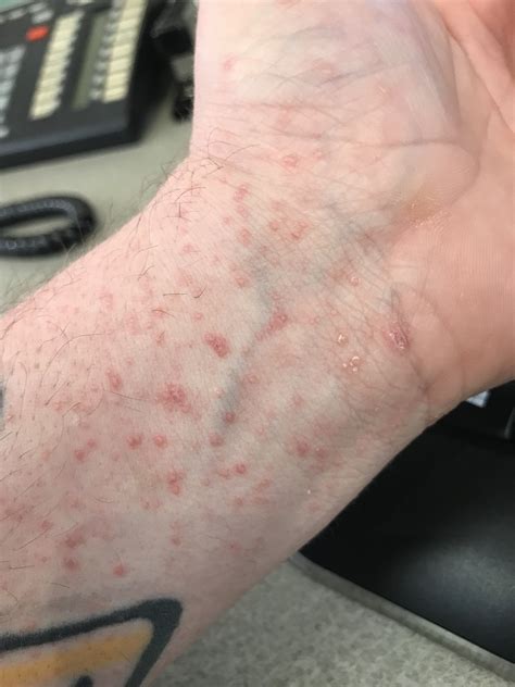 A Rash Has Developed On Hands Chest Belly And Feet Ask A Doctor