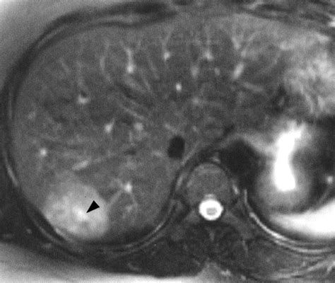 Ct And Mr Imaging Findings In Focal Nodular Hyperplasia Of The Liver