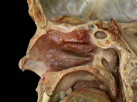 The nasal cavity is separated into halves by the partially bony and partially cartilaginous nasal septum. Lining of the nasal cavity | Acland's Video Atlas of Human ...