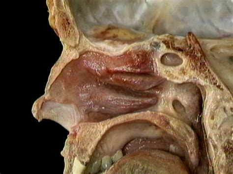 The nasal cavity (or cavity of nose, latin: Lining of the nasal cavity | Acland's Video Atlas of Human ...